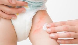 La dermatitis de pañal en bebés